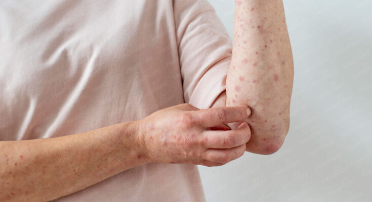 Skin allergy 1024x536